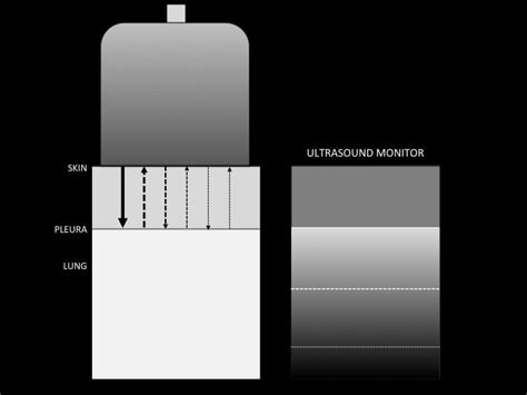 Long path reverberation artefact • LITFL • Ultrasound Library Basics