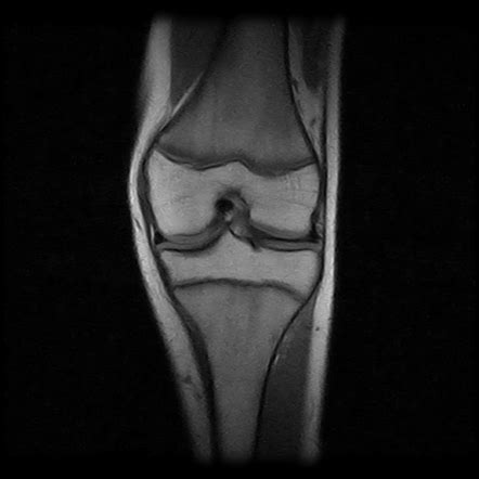 Sinding Larsen Johansson Disease Image Radiopaedia Org