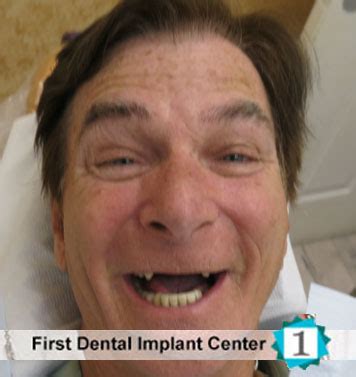 Affordable Dental Implants Woodland Hills Thousand Oaks Simi Valley