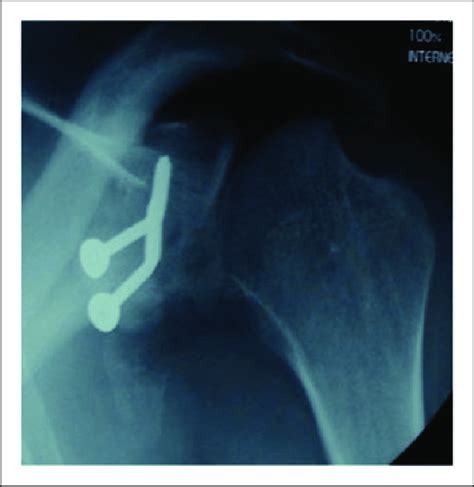 Typical Aspect Of Failure After Latarjet Procedure In Epileptic