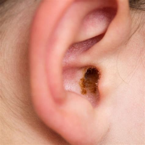 What Is Ear Wax A Simple Guide Earlab