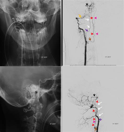 Case Archives Anterior Spinal Artery Duplication Neuroangio Org