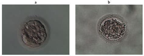 Reprod Med Free Full Text A Case Of Sex Discordant Dichorionic