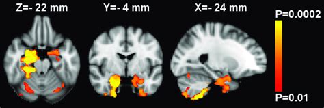 Whole Brain Voxel Based Morphometry Analysis Of Gray Matter Density