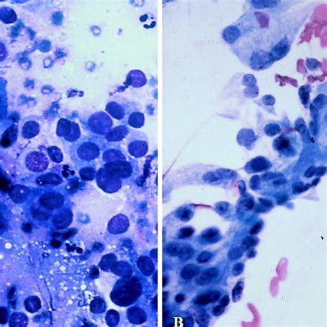 Fine Needle Aspiration Biopsy Smears From A Renal Cell Carcinoma