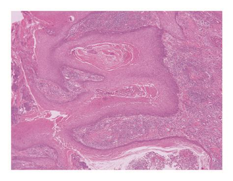 Representative Pathological Features Of Penile Squamous Cell Carcinoma Download Scientific