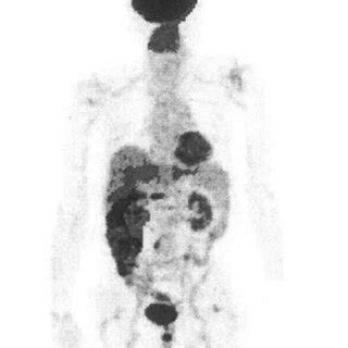 Positron Emission Tomography Computed Tomography Examination