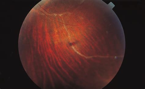 Leber S Hereditary Optic Neuropathy Masquerading As Retinal Vasculitis