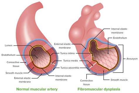 Fibromuscular Dysplasia Concise Medical Knowledge