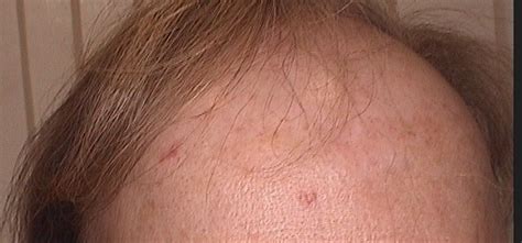 Frontal Fibrosierende Alopezie Derma Plus