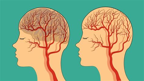 Symptoms Of Mini Stroke