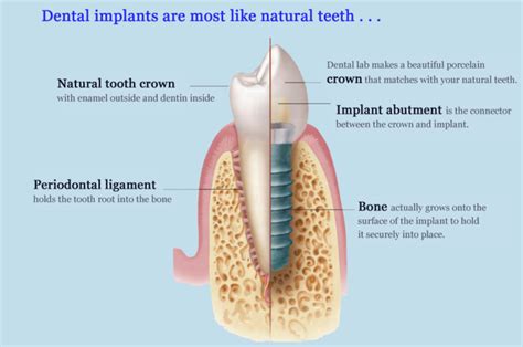 Dental Implant Procedure: New & Improved