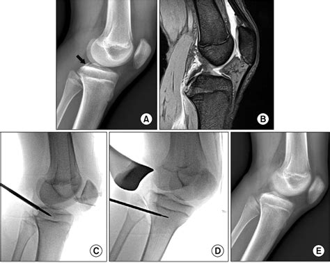 A Preoperative Lateral Radiograph Of Displaced Posterior Cruciate Download Scientific Diagram