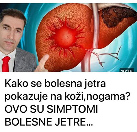 Koji Su Vidljivi Znakovi Disfunkcije Jetre Na Ko I I Nogama Ovo Su