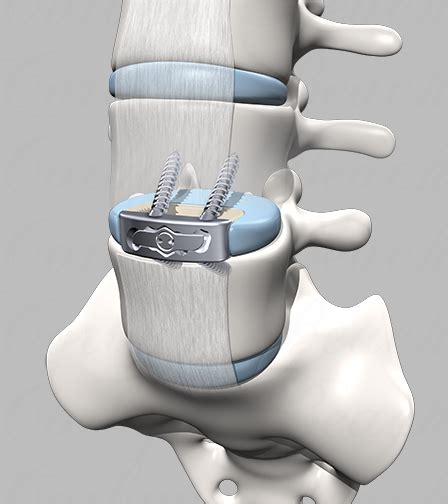 Corbyn Beach A Link Z Spinal Fusion Implant