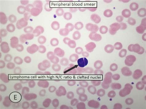 Non Hodgkin Lymphoma Flashcards Quizlet