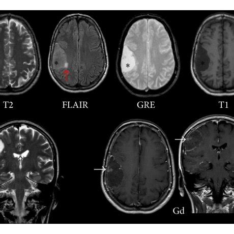 Gadolinium Enhanced Brain Mri The Lesion Is Hypointense On T And