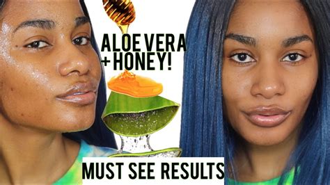 Raw Honey For Acne Before And After