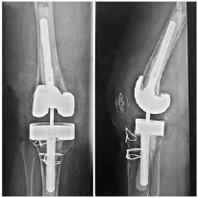 Artroplastia Total De Rodilla Con Implante Semiconstre Ido An Lisis De