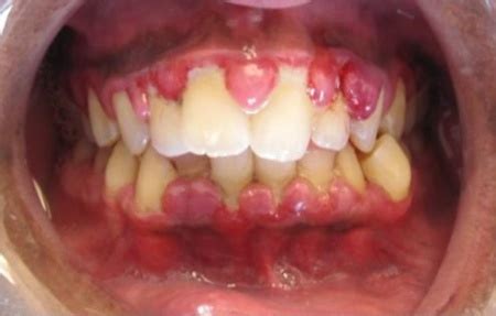 gingival hyperplasia wikem