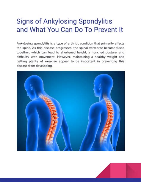 Ppt Signs Of Ankylosing Spondylitis And What You Can Do To Prevent It