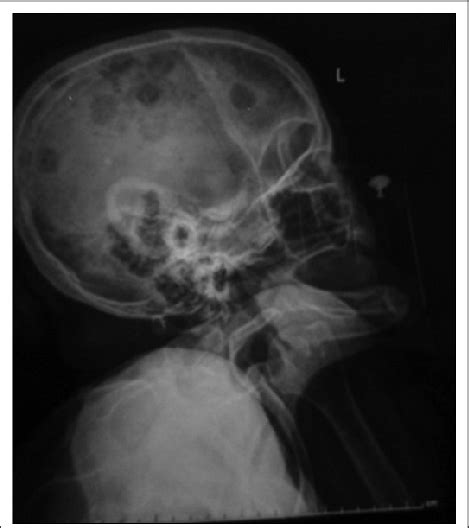 X Rays Of Skull Lateral View X Ray Shows Multiple Punched Out Lytic Download Scientific