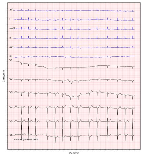 Atrial fibrillation: ECG, classification, causes, risk factors ...