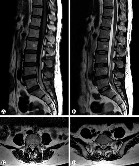 Mri Showing A Longitudinal Space Occupying Lesion Extending From T12 To