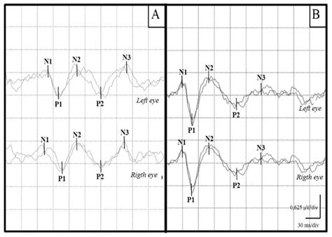 Prolonged Visual Evoked Potential Latencies in Dogs Naturally Infected