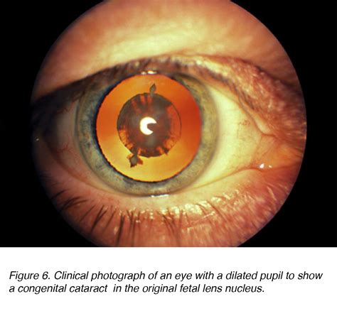 Crystalline Lens And Cataract By Joah F Aliancy And Nick Mamalis