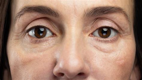 Can Dehydration Cause Dry Eyes The Answer May Surprise You