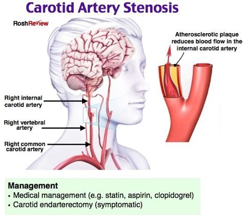 Carotid Artery Stenosis | Medical knowledge, Pharmacology nursing ...