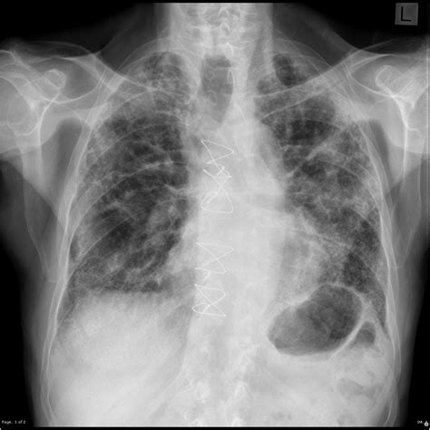 Pulmonary Fibrosis Xray