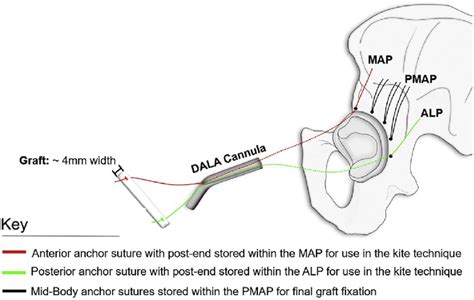 Illustrated Diagram Depicting The Kite Technique For Labral