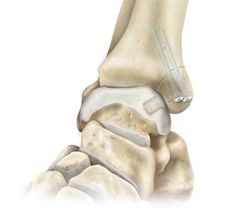 Medial Malleolus