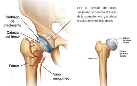 Enfermedad De Perthes Dr Delgado DELGADOTRAUMA