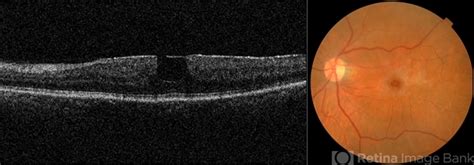 Macular Pseudohole - Retina Image Bank