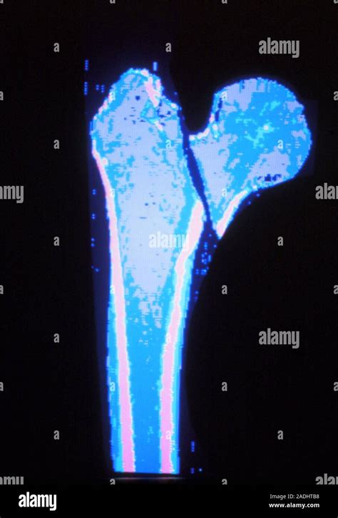 Broken Hip Coloured Computed Tomography CT Scan Of A Fracture