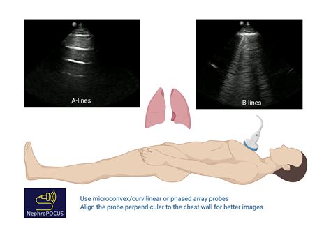 Lung ultrasound: A and B-lines – NephroPOCUS