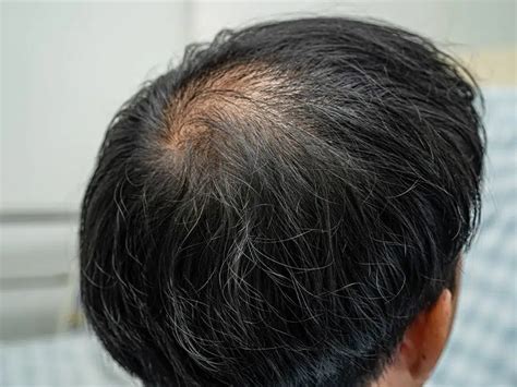 What Causes Androgenic Alopecia 5 Reasons And How To Fix It