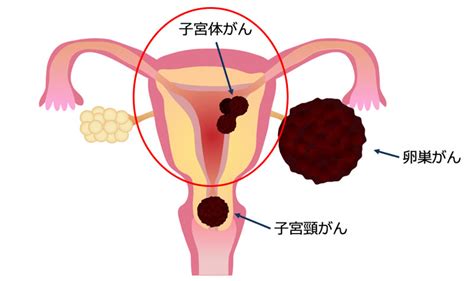 腫瘍京都府立医科大学 産婦人科学教室