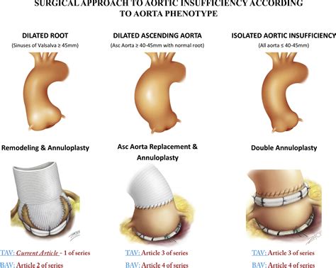 Valve Sparing Aortic Root Replacement Using The Remodeling Technique