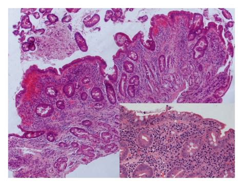 Duodenal Biopsy Following Four Year History Of Positive Ttg Antibodies