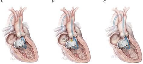 Lampoon Techniques To Prevent Or Manage Left Ventricular Outflow Tract