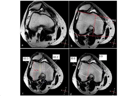 a-d MRI images for lateral patellar subluxation with trochlear ...