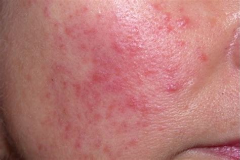 Studypages - Do You Have Rosacea with Bumps? Participate in a research ...