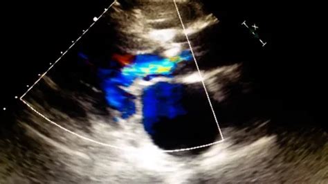 Echocardiography (ultrasound examination... | Stock Video | Pond5