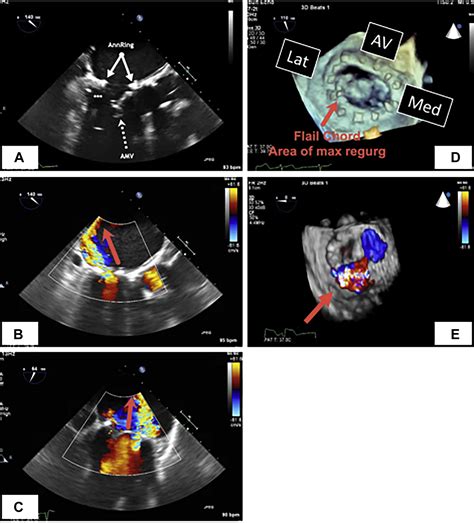 Clipping The Ring Transcatheter Edge To Ring Mitral Valve Repair In A