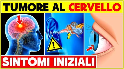 Segni E Sintomi Iniziali Di Un Tumore Al Cervello Non Ignorare