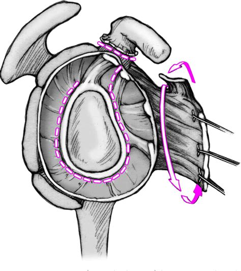 Pdf Subscapularis Dysfunction Following Anterior Surgical Approaches